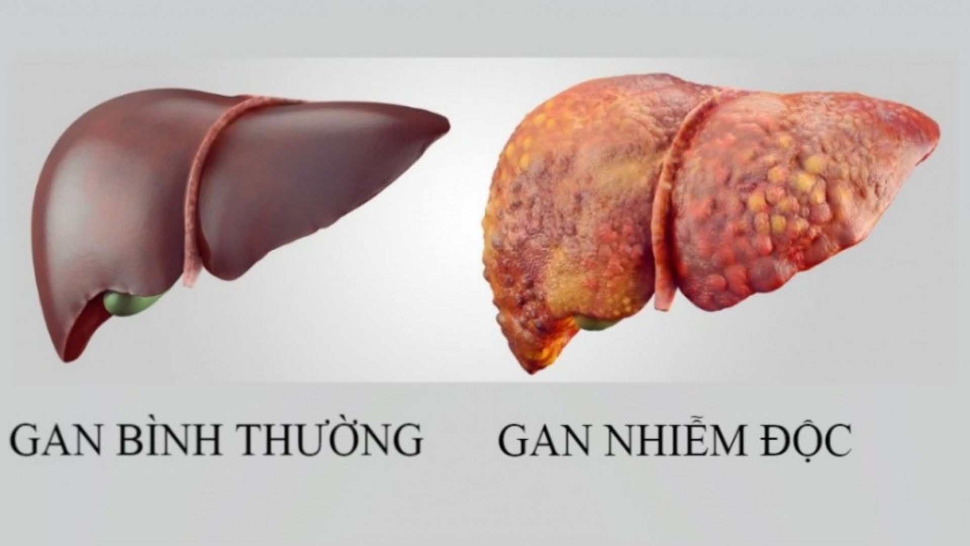 Cải thiện tình trạng gan nhiễm độc với 5 mẹo thải độc hiệu quả