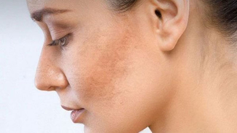 Cơ thể mệt mỏi, da mặt sạm đen là bệnh gì?